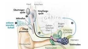 Das Cochlea Implantat – Endlich wieder hören können!